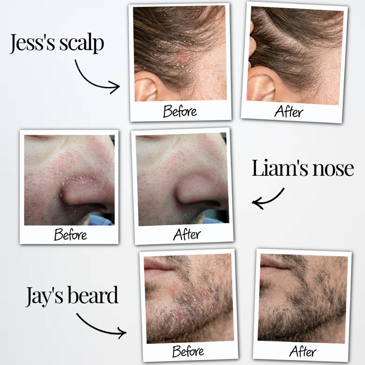 Anti-Dandruff Serum